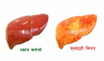 फ्याटी लिभरको समस्यालाई कसरी नियन्त्रण गर्ने?